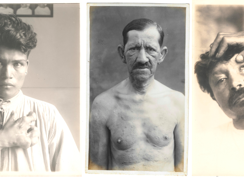 La primera y la última fotografía hacen parte de los Álbumes de patología exótica Tomo I, Ca. 1930-1932, atribuidas a Roberto San Martín Latorre. Museo Ricardo Rueda González Academia Nacional de Medicina. La foto de que está en medio ‘Paciento con facies leonina. 1940, fotógrafo desconocido’, hace parte del Archivo Fotográfico del Museo de la Lepra del Sanatorio Agua de Dios. Fotos Cortesía.