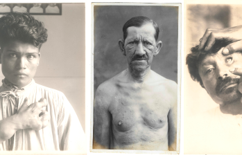 La primera y la última fotografía hacen parte de los Álbumes de patología exótica Tomo I, Ca. 1930-1932, atribuidas a Roberto San Martín Latorre. Museo Ricardo Rueda González Academia Nacional de Medicina. La foto de que está en medio ‘Paciento con facies leonina. 1940, fotógrafo desconocido’, hace parte del Archivo Fotográfico del Museo de la Lepra del Sanatorio Agua de Dios. Fotos Cortesía.